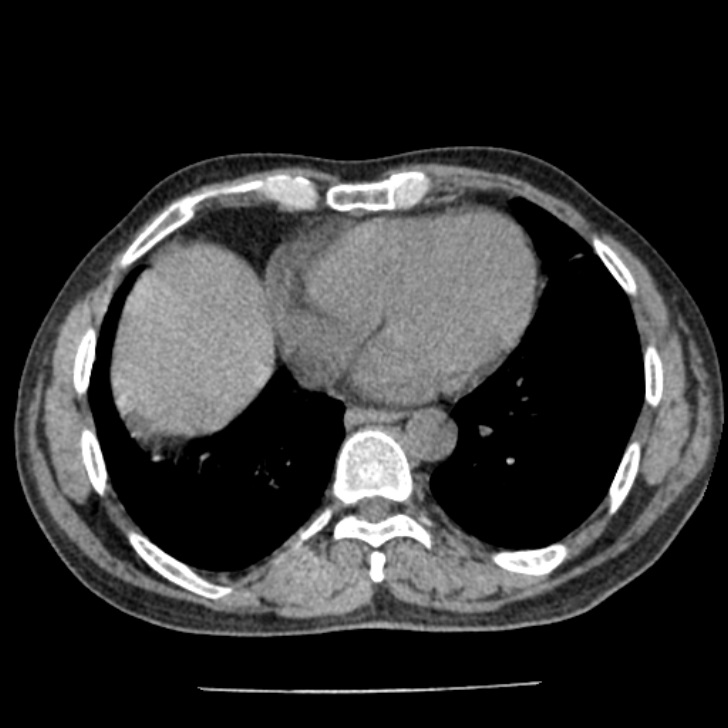 Airway foreign body in adult (Radiopaedia 85907-101779 Axial liver window 130).jpg