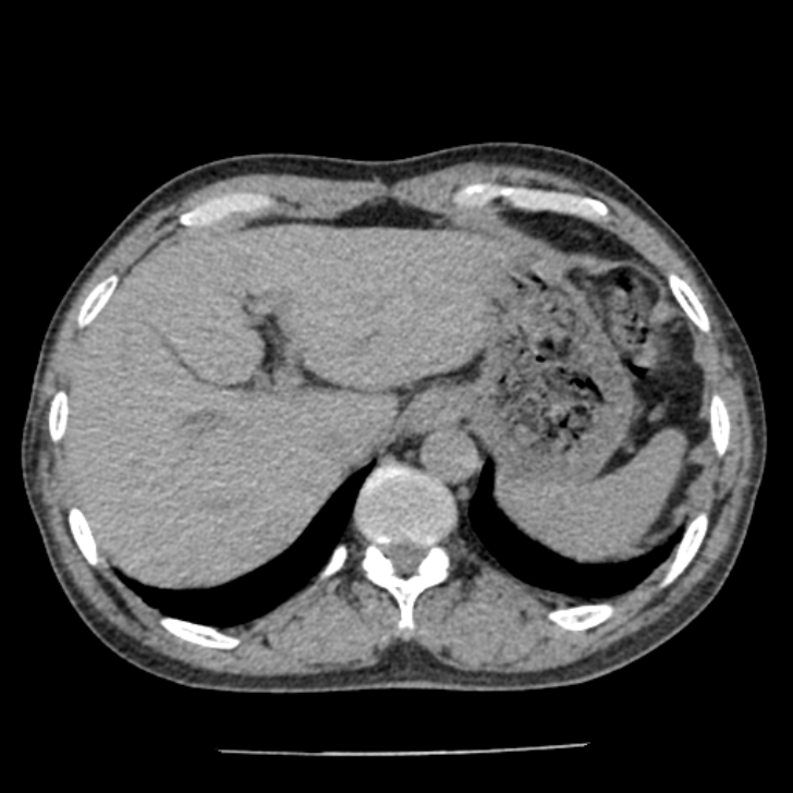 Airway foreign body in adult (Radiopaedia 85907-101779 Axial liver window 189).jpg