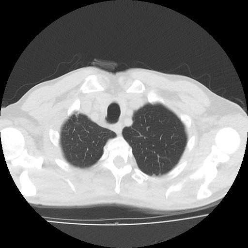 Allergic bronchopulmonary aspergillosis (ABPA) (Radiopaedia 60594-68313 Axial lung window 7).jpg
