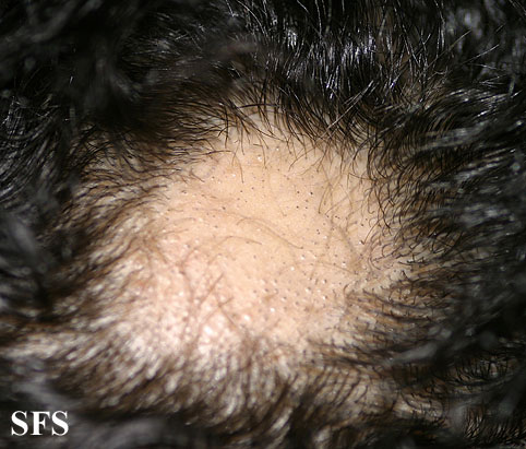 Alopecia Areata (Dermatology Atlas 12).jpg