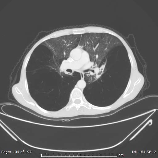 Alpha-1-antitrypsin deficiency (Radiopaedia 50561-55987 Axial lung window 43).jpg