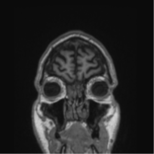 Alzheimer's disease- with Gerstmann syndrome and dressing apraxia (Radiopaedia 54882-61150 Coronal T1 83).png