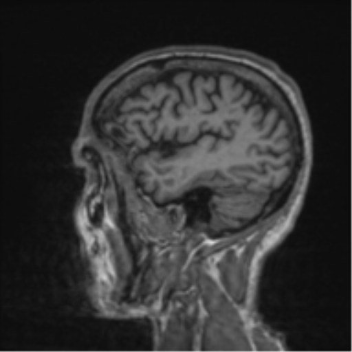 Alzheimer's disease- with apraxia (Radiopaedia 54763-61011 Sagittal T1 14).png