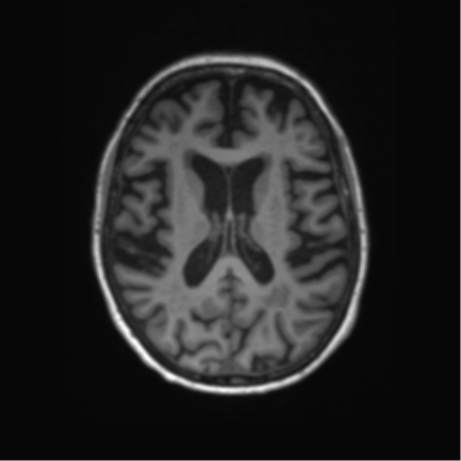File:Alzheimer's disease (Radiopaedia 42658-45802 Axial T1 69).png