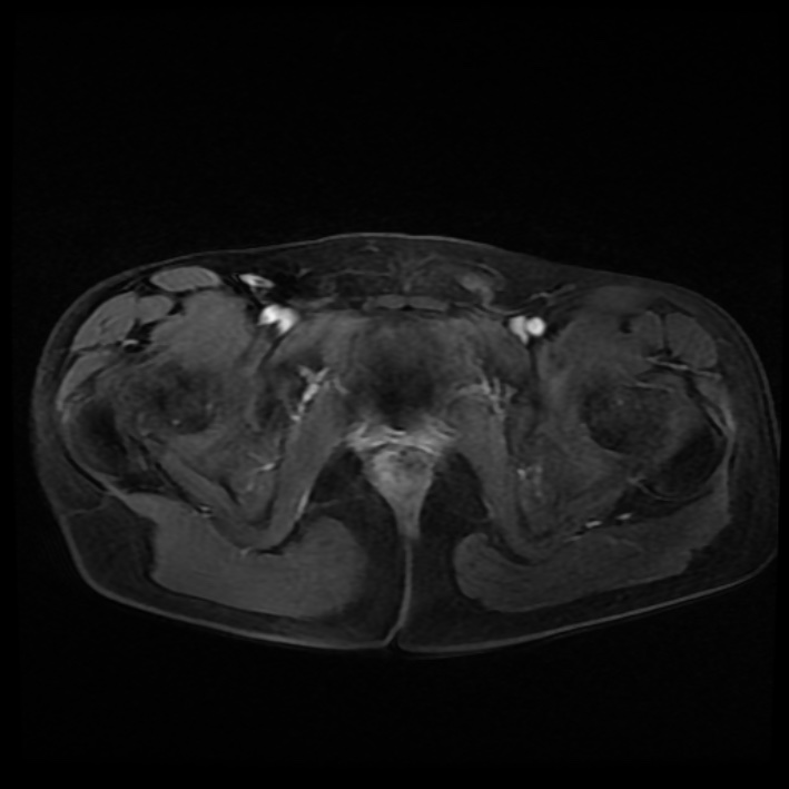 Ambiguous genitalia (Radiopaedia 69686-79643 Axial T1 C+ fat sat 41).jpg