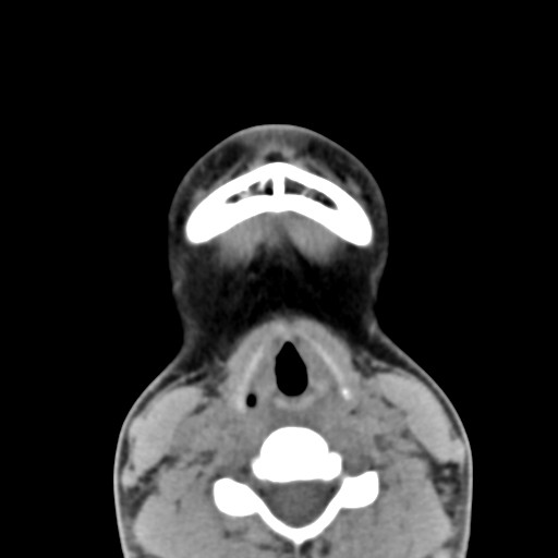 File:Ameloblastoma (Radiopaedia 26645-26793 Axial C+ delayed 6).jpg