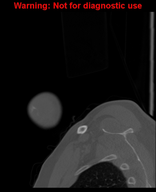 Ameloblastoma (Radiopaedia 33126-34164 Sagittal bone window 7).jpg