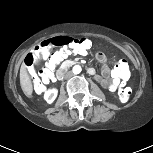File:Ampullary adenocarcinoma (Radiopaedia 34013-35237 B 46).png