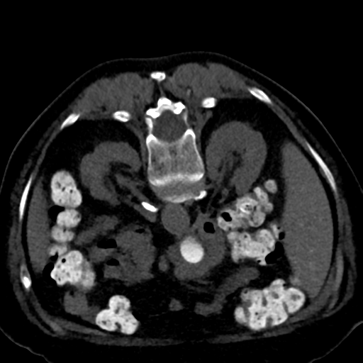Ampullary adenocarcinoma (Radiopaedia 34013-35241 C 43).png