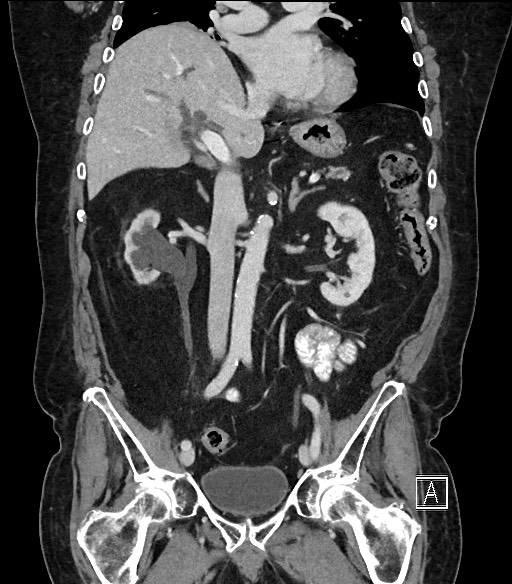 Ampullary adenocarcinoma (Radiopaedia 59373-66734 D 53).jpg