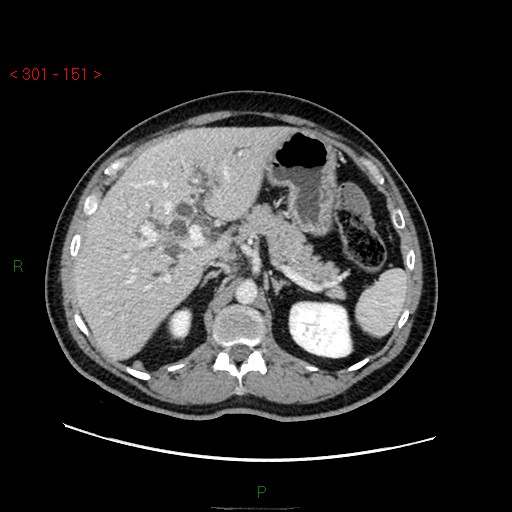 File:Ampullary carcinoma (Radiopaedia 56396-63056 C 28).jpg