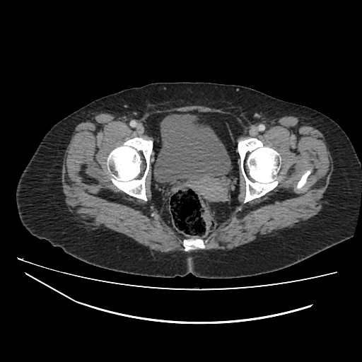 Ampullary tumor (Radiopaedia 60333-67998 A 86).jpg