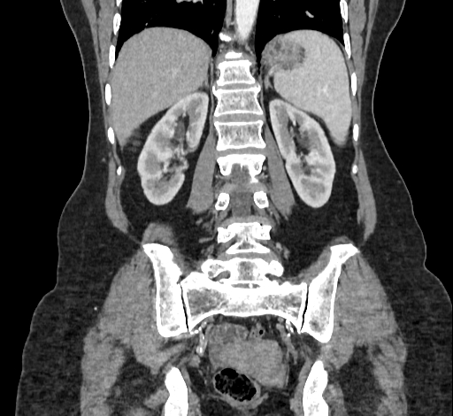 Ampullary tumor (Radiopaedia 60333-67998 B 55).jpg