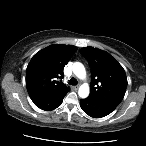 Amyloidosis - bronchial and diffuse nodular pulmonary involvement (Radiopaedia 60156-67745 A 18).jpg