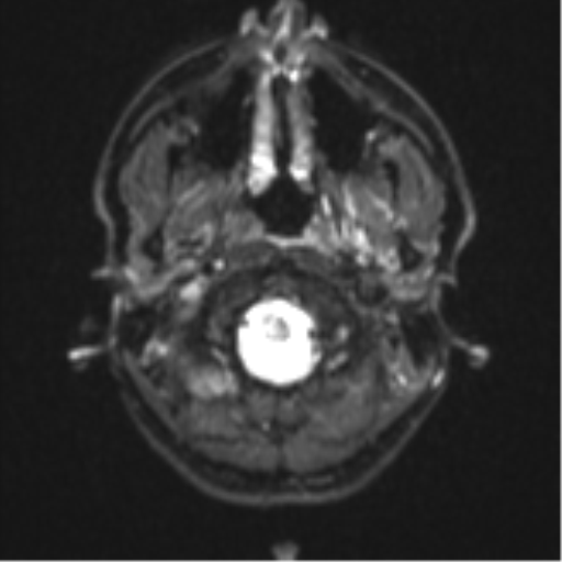 Anaplastic astrocytoma (Radiopaedia 57768-64731 Axial DWI 1).png