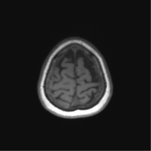 Anaplastic astrocytoma (Radiopaedia 86943-103160 Coronal T1 81).png