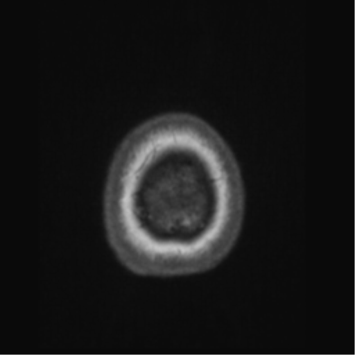 File:Anaplastic astrocytoma IDH wild-type (pseudoprogression) (Radiopaedia 42209-45276 Axial T1 147).png