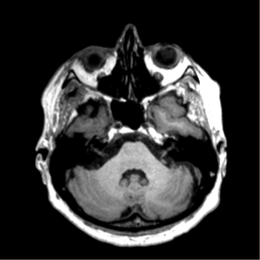 Anaplastic astrocytoma IDH wild-type (pseudoprogression) (Radiopaedia 42209-45277 Axial T1 32).png