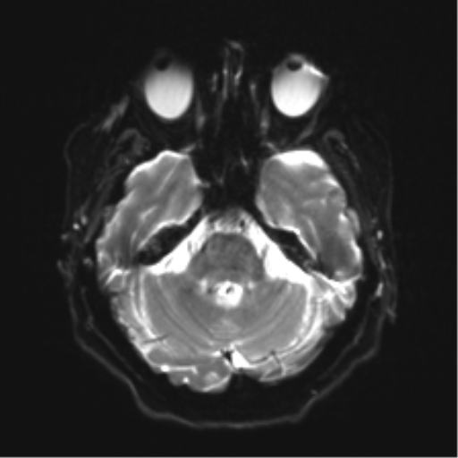 Anaplastic astrocytoma IDH wild-type (pseudoprogression) (Radiopaedia 42209-45279 Axial DWI 8).png
