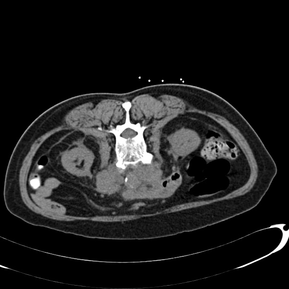 File:Anaplastic lymphoma - with CT biopsy (Radiopaedia 21643-21602 Axial non-contrast 36).jpg