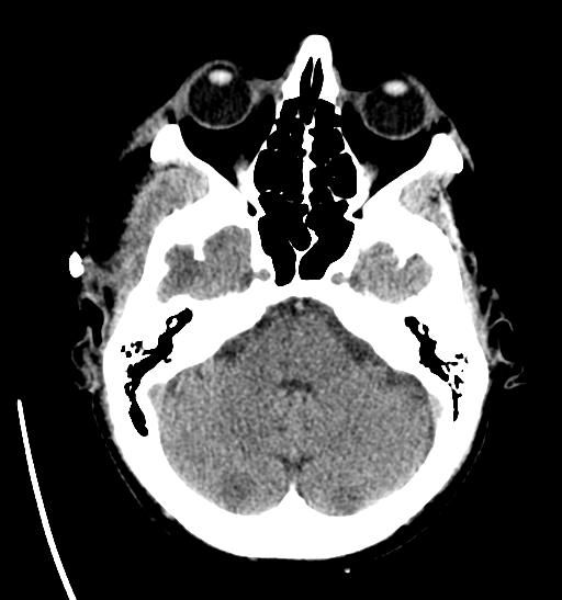File:Anaplastic meningioma with recurrence (Radiopaedia 34452-35786 Axial non-contrast 9).png