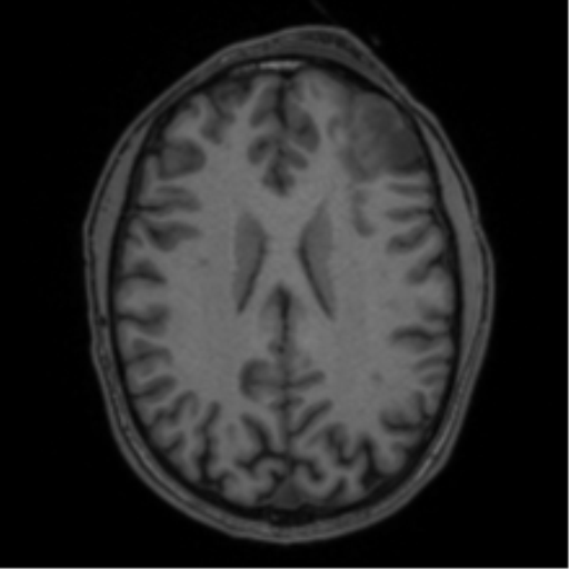 Anaplastic oligodendroglioma with skull fracture (Radiopaedia 74831-85845 Axial T1 40).png