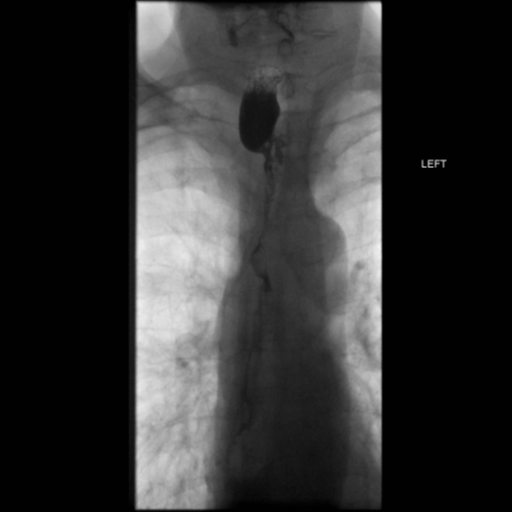 File:Anastomotic stricture post Ivor Lewis esophagectomy (Radiopaedia 47937-52715 B 17).png