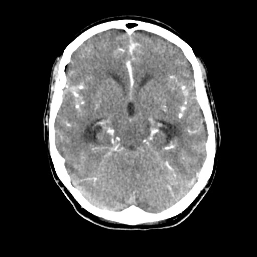 Aneursym related subarachnoid hemorrhage with hydrocephalus (Radiopaedia 45105-49084 D 21).jpg