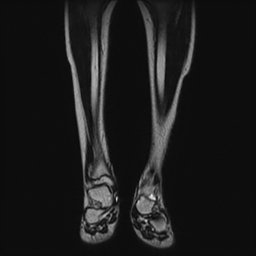 File:Aneurysmal bone cyst - tibia (Radiopaedia 22343-22367 Coronal T2 6).jpg