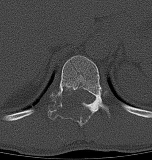 File:Aneurysmal bone cyst T11 (Radiopaedia 29294-29721 Axial bone window 43).jpg