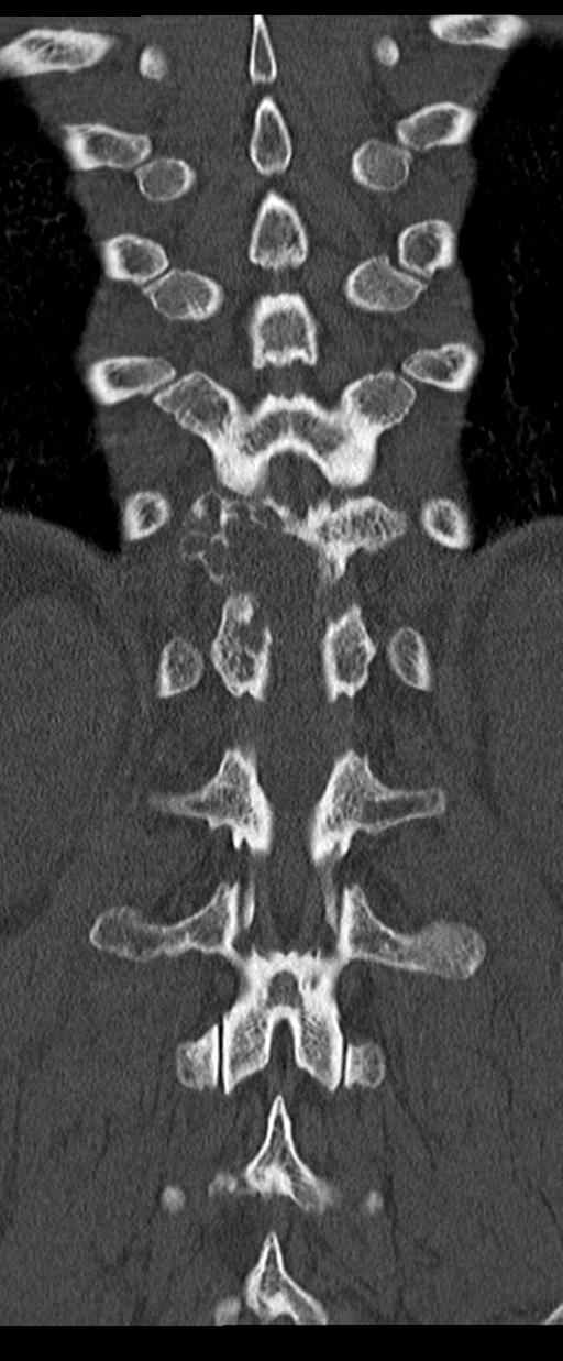 Aneurysmal bone cyst T11 (Radiopaedia 29294-29721 Coronal bone window 46).jpg