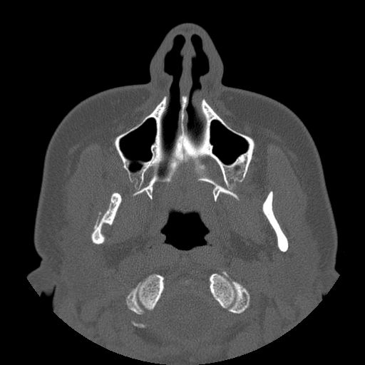 File:Aneurysmal bone cyst of the mandible (Radiopaedia 43280-46823 Axial bone window 105).jpg