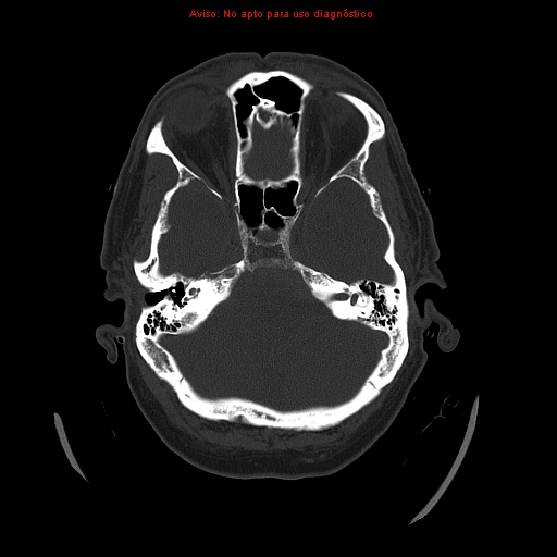 File:Aneurysmal subarachnoid hemorrhage (Radiopaedia 24740-24997 bone window 10).jpg