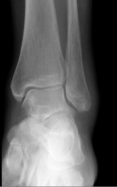 File:Ankle fracture - Weber A (Radiopaedia 12267-12567 Frontal 1).jpeg
