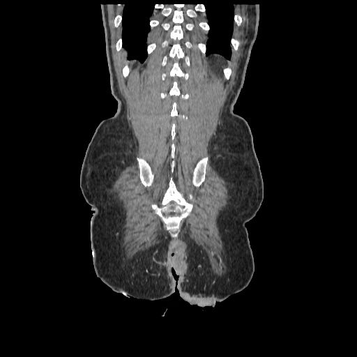 Anorectal carcinoma (Radiopaedia 44413-48064 B 81).jpg