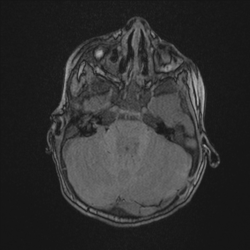 Anoxic brain injury (Radiopaedia 79165-92139 Axial MRA 58).jpg