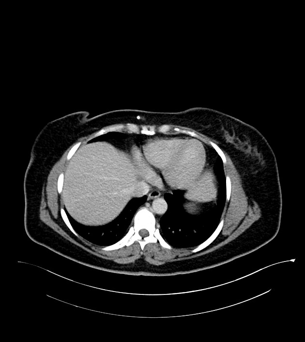 Anterior abdominal wall CSF pseudocyst (CSFoma) (Radiopaedia 79453-92571 A 13).jpg