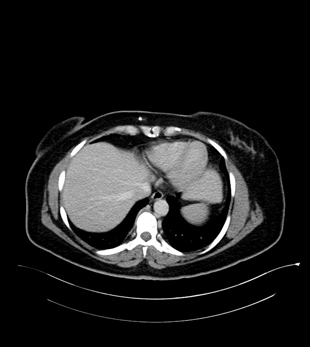 Anterior abdominal wall CSF pseudocyst (CSFoma) (Radiopaedia 79453-92571 A 14).jpg