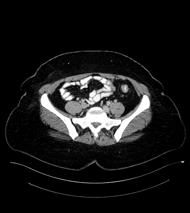 Anterior abdominal wall CSF pseudocyst (CSFoma) (Radiopaedia 79453-92571 A 66).jpg
