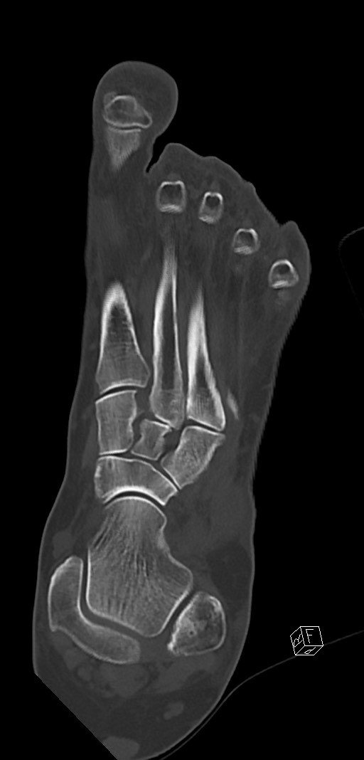 Anterior calcaneal process fracture (Radiopaedia 63353-71943 Coronal bone window 20).jpg