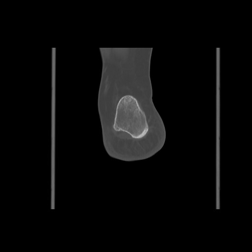 File:Anterior calcaneal process fracture (Radiopaedia 82590-96762 Coronal bone window 68).jpg