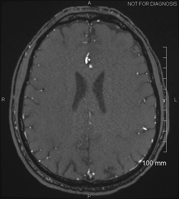 Anterior cerebral artery aneurysm (Radiopaedia 80683-94127 Axial MRA 165).jpg
