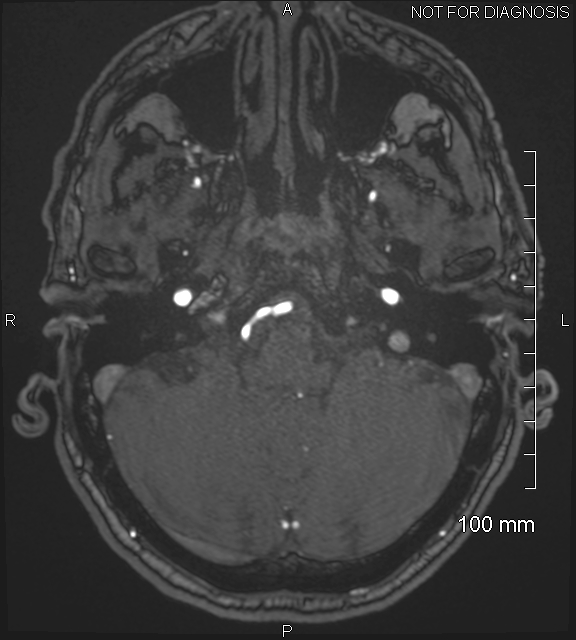 Anterior cerebral artery aneurysm (Radiopaedia 80683-94127 Axial MRA 42).jpg