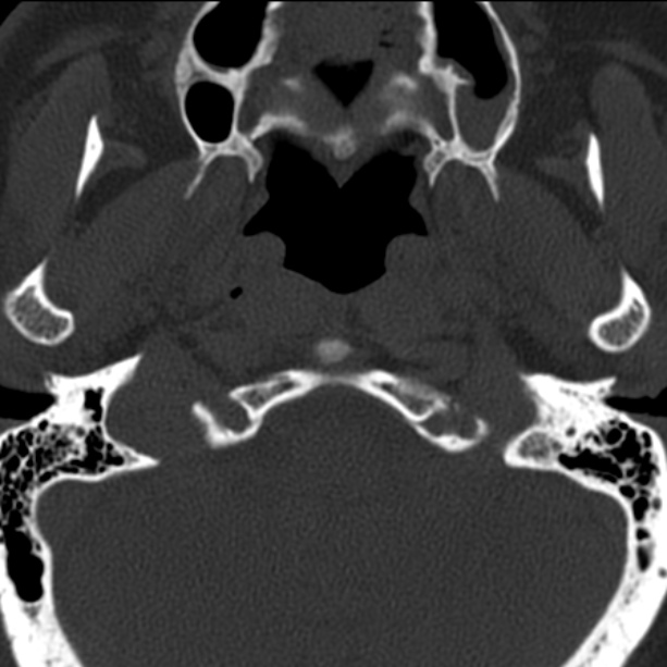Anterior cervical postdiscectomy arthrodesis (Radiopaedia 32678-33646 Axial bone window 4).jpg