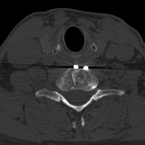 Anterior cervical postdiscectomy arthrodesis (Radiopaedia 32678-33646 Axial bone window 55).jpg