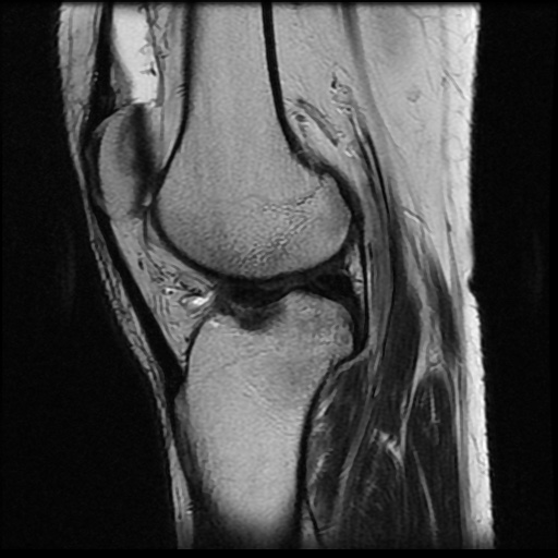 File:Anterior cruciate ligament avulsion fracture (Radiopaedia 58939-66193 Sagittal T2 9).jpg