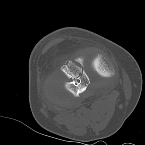 File:Anterior cruciate ligament avulsion fracture (Radiopaedia 58939-66194 Axial bone window 15).jpg