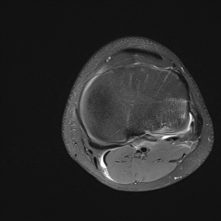 File:Anterior cruciate ligament tear - pediatric (Radiopaedia 62152-70260 Axial PD fat sat 28).jpg
