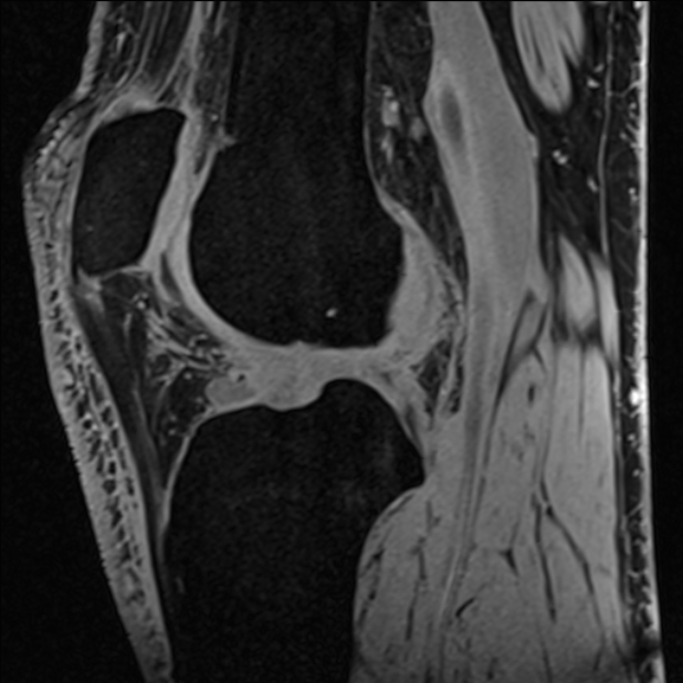 Anterior cruciate ligament tear - ramp lesion (Radiopaedia 71883-82322 Sagittal T1 vibe 64).jpg