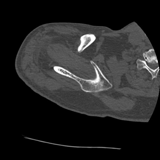 Anterior glenohumeral dislocation with Hill-Sachs lesion (Radiopaedia 62877-71249 Axial bone window 19).jpg